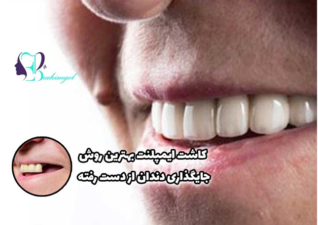ایمپلنت فوری دندان چیست؟ | مزایا، عوارض و مراحل